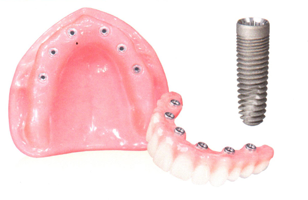 Fixed Implant Denture