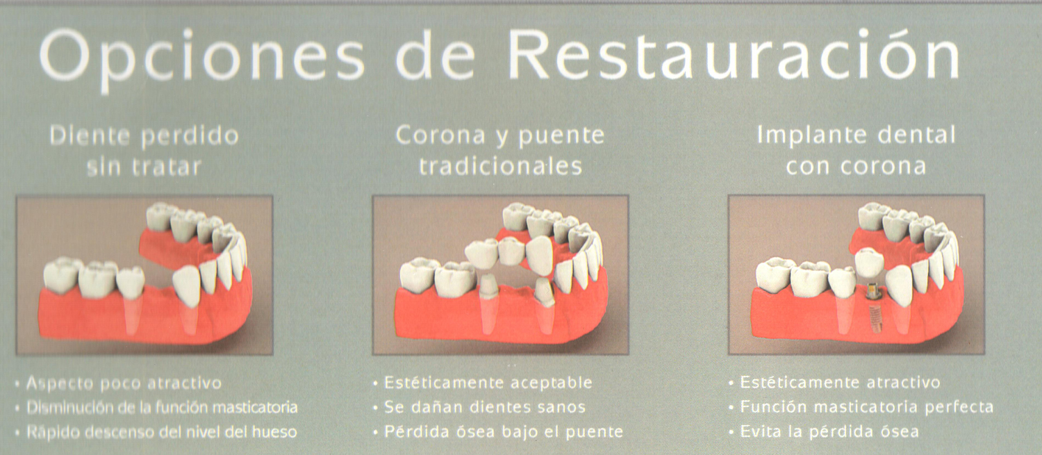 Implantes Dentales Ilustracion Opciones Restauracion
