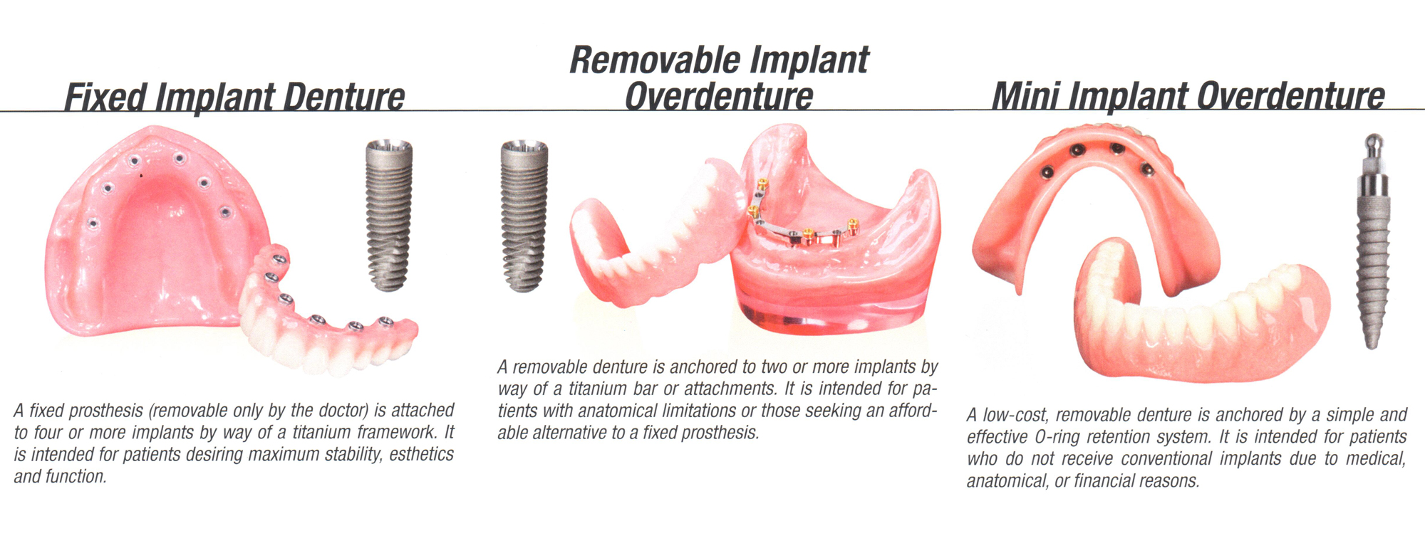 Implantes Dentales Variedades