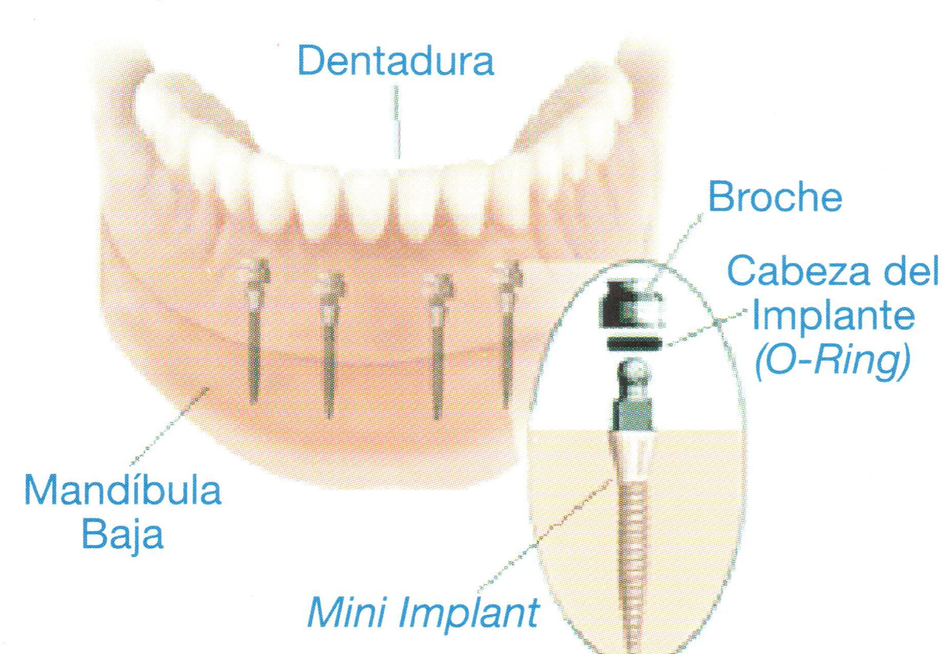 Mini Implante