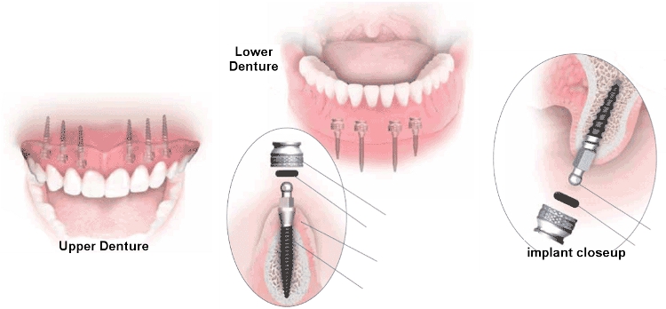 Mini Implantes Denture Closeup