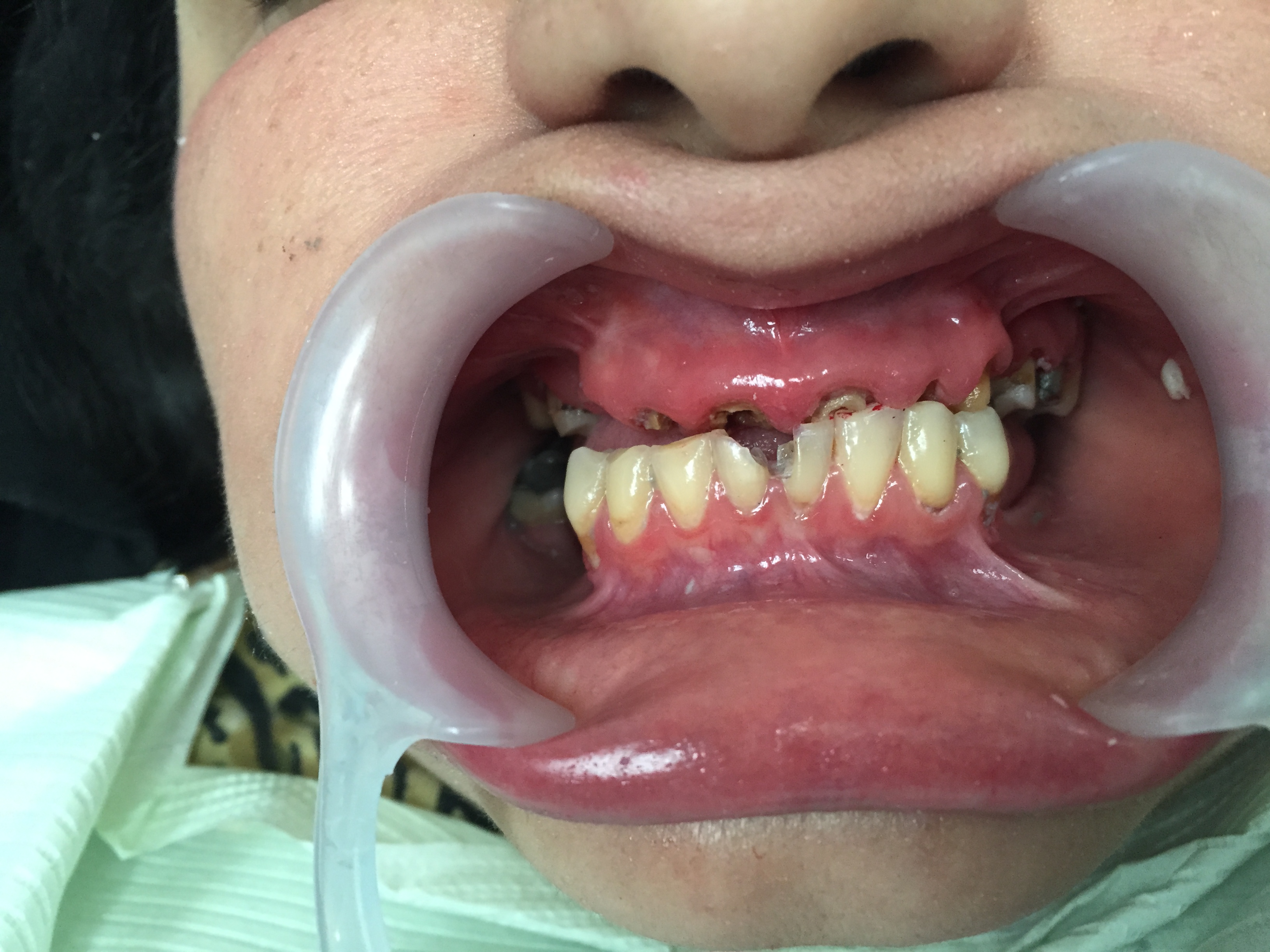 Caso-Dental-Agosto-2015-2-BW